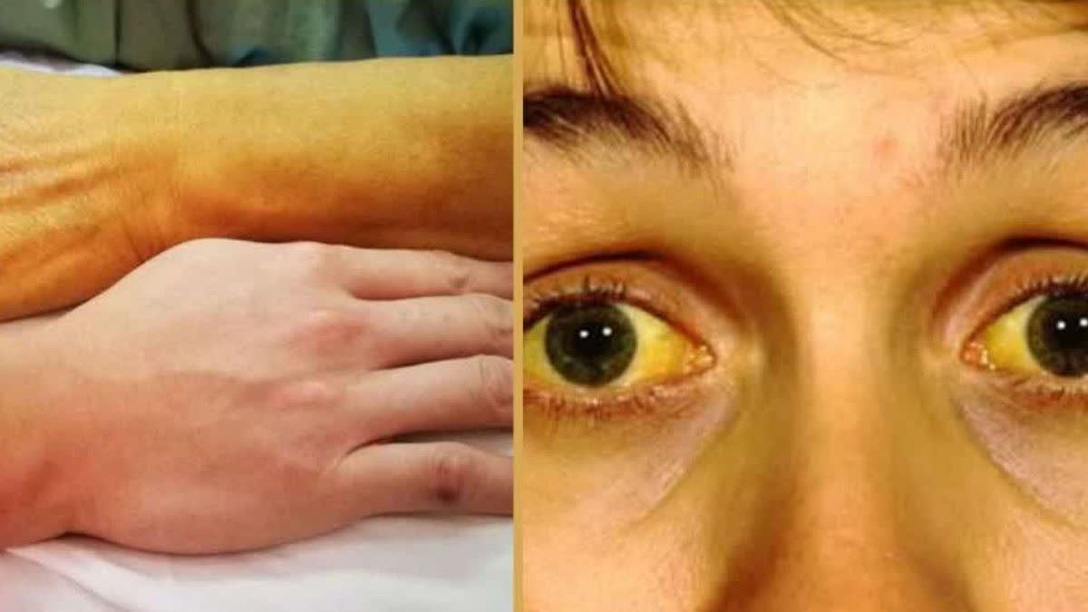 भिलाई सेक्टर-7 में पीलिया का प्रकोप: 22 बच्चे संक्रमित, 2 ICU में भर्ती, दूषित पानी पर उठे सवाल